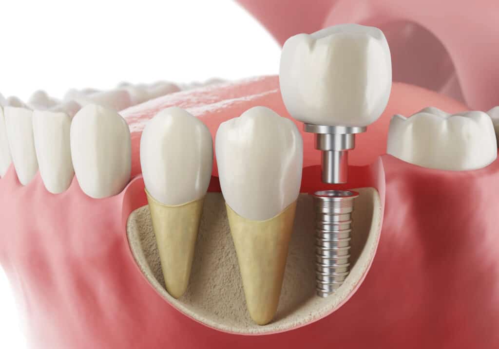 Dental implant care tips illustration showing a titanium implant, abutment, and crown replacing a missing tooth.