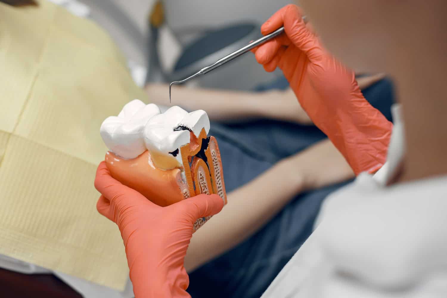Dental model showing tooth decay during root canal treatment to help save the natural tooth.