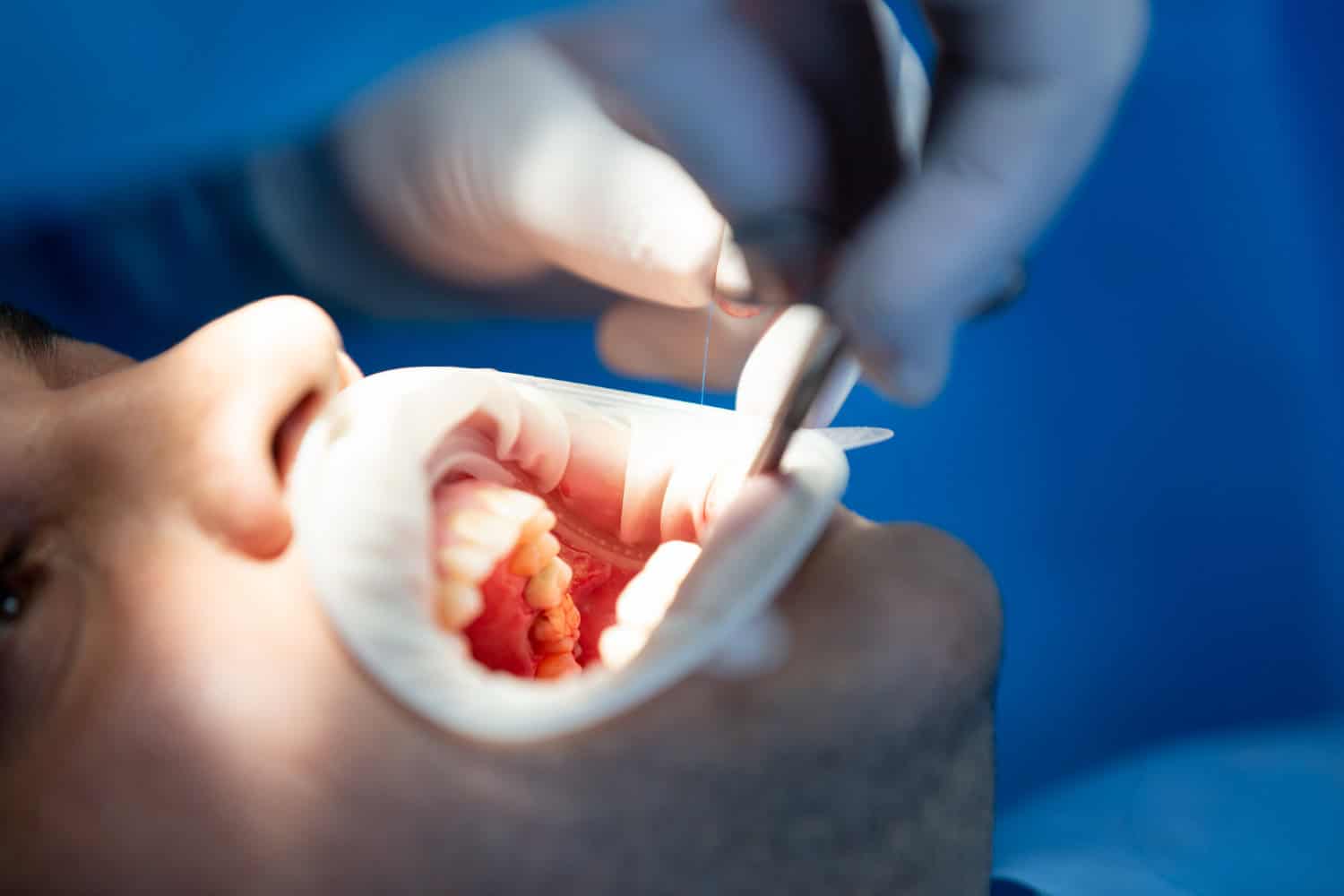 Dentist examining a patient's teeth before dental crown treatment using professional dental instruments in a modern dental clinic.